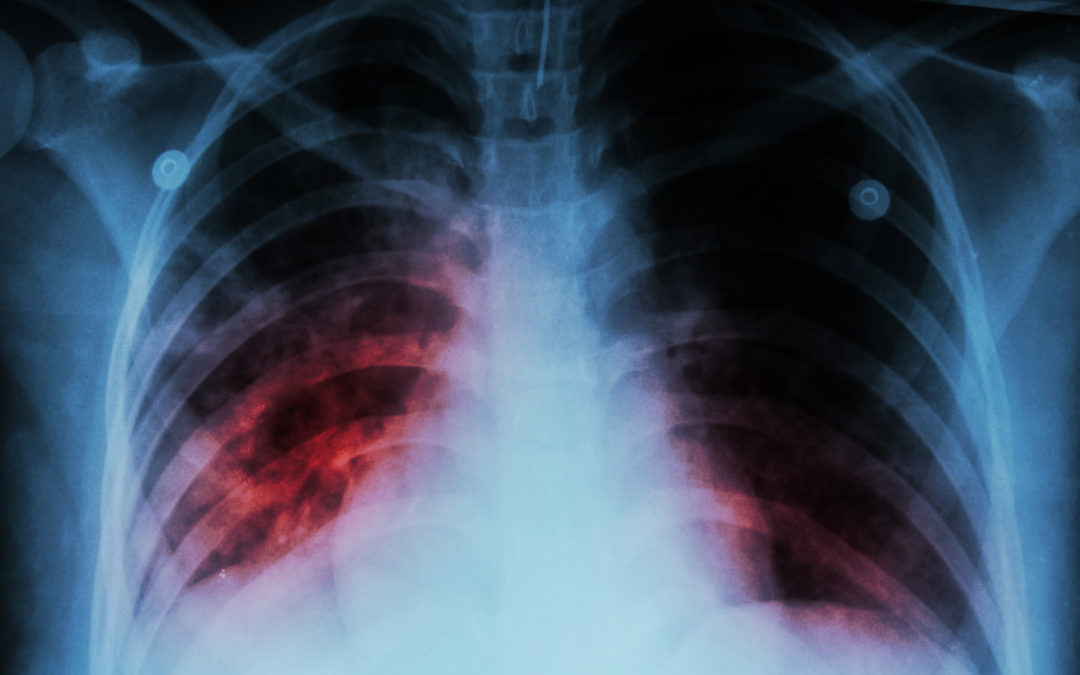The Phantom Plague: Vidya Krishnan Traces the History of Tuberculosis