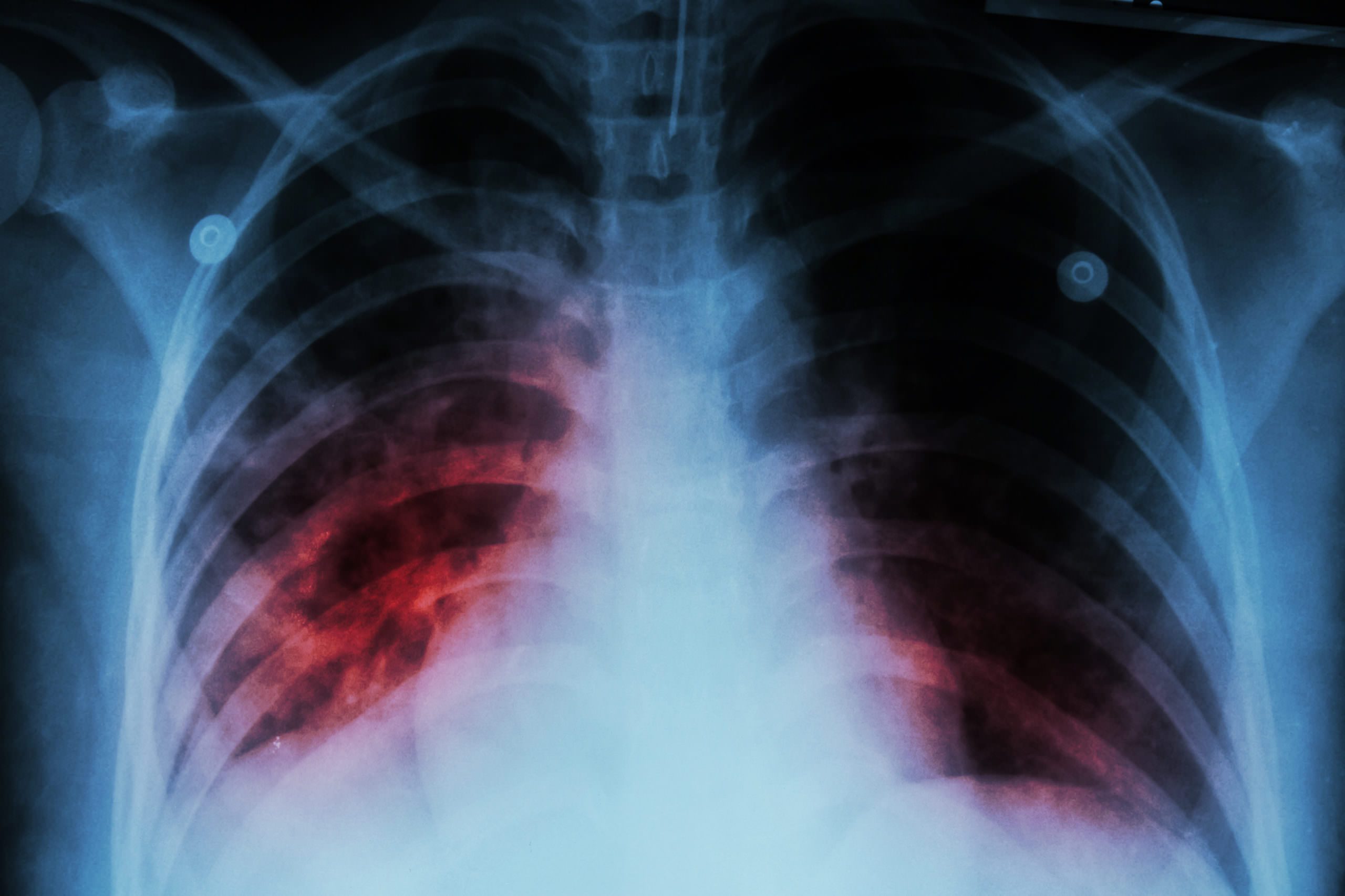 The Phantom Plague Vidya Krishnan Traces The History Of Tuberculosis • The Lakshmi Mittal And 